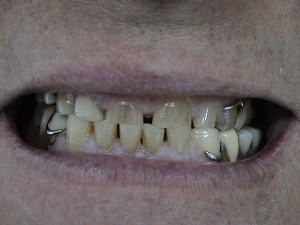 Bruxismo "desgaste dental "